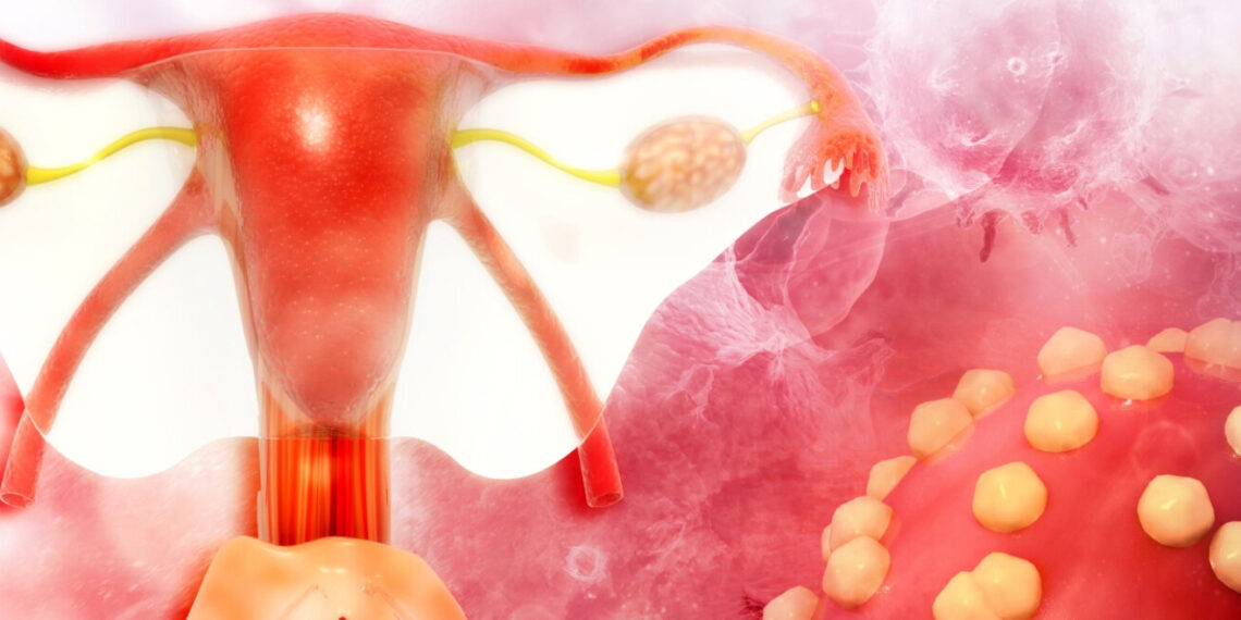 Dreptul la viață. Statul, obligat în instanță să le plătească un medicament costisitor. Femeile suferă de cancer