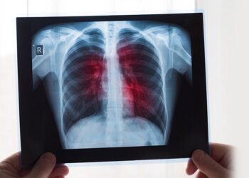 Cântăreț celebru, diagnosticat cu cancer la plămâni