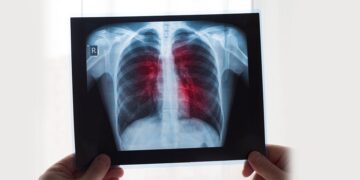 Cântăreț celebru, diagnosticat cu cancer la plămâni