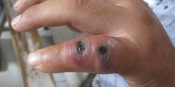 Suspiciuni de antrax. Bihoreanca prezintă plăci negricioase și are febră