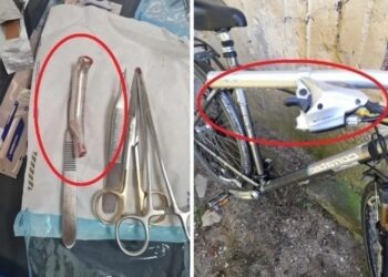 Un medic a uitat frâna de bicicletă în rana unui pacient. ”Când am urcat treptele pur și simplu a pleznit pielea din jurul cusăturii”