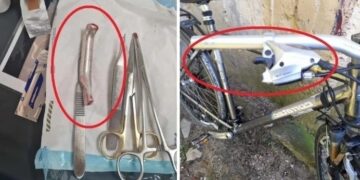 Un medic a uitat frâna de bicicletă în rana unui pacient. ”Când am urcat treptele pur și simplu a pleznit pielea din jurul cusăturii”