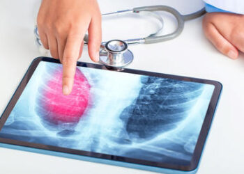 Un nou medicament împotriva cancerului pulmonar, autorizat.A ajutat la micșorarea sau reducerea tumorii la 79% dintre pacienții care nu primiseră anterior niciun tratament cu TKI