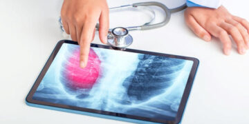 Un nou medicament împotriva cancerului pulmonar, autorizat.A ajutat la micșorarea sau reducerea tumorii la 79% dintre pacienții care nu primiseră anterior niciun tratament cu TKI