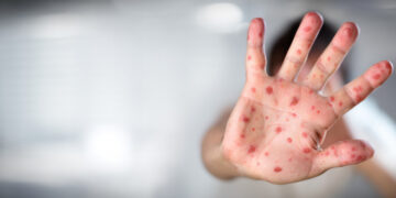 Ministerul Sănătății a declarat epidemie de rujeolă în România2.000 de cazuri la nivel național, în 29 de județe