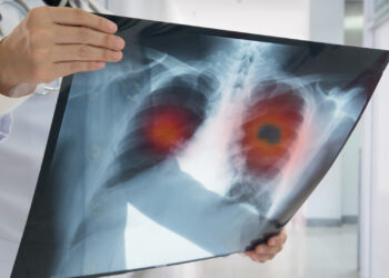 Bihorul printre cele 16 județe unde nivelul de radon depășește concentrația admisă. E gazul vinovat de creșterea numărului de cazuri de cancer pulmonar