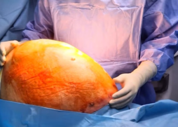 Au extirpat un chist ovarian gigant de 10 kg