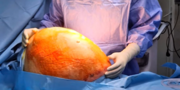 Au extirpat un chist ovarian gigant de 10 kg